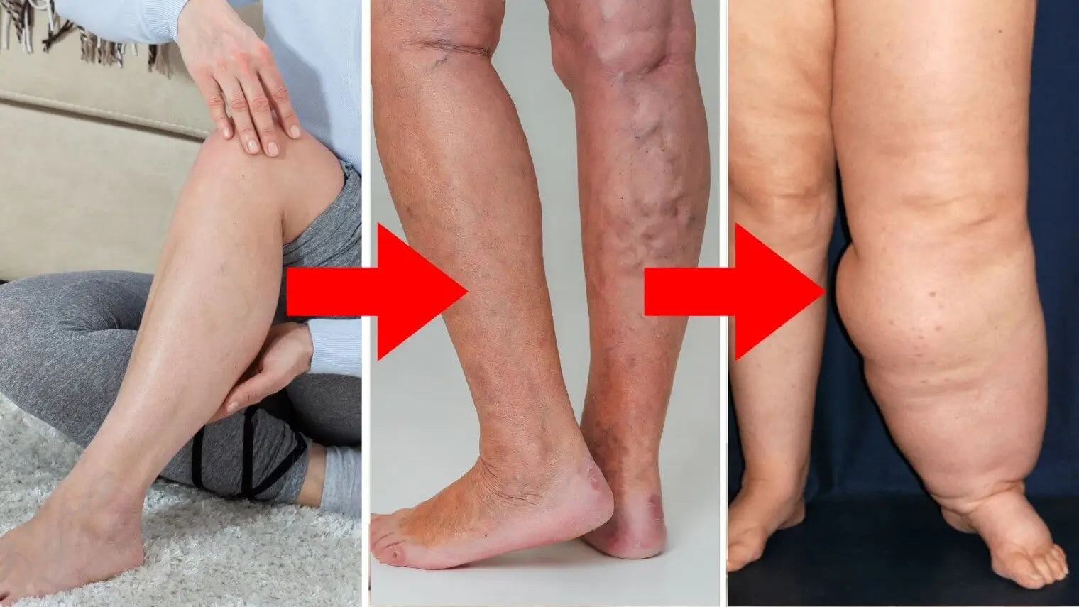 Lymphedema So Bad You Could Barely Recognize What Body Part You’re Looking At
