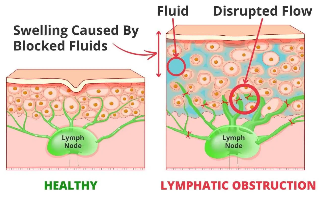 Shocking Truth: The Real Root Cause of Lymphedema